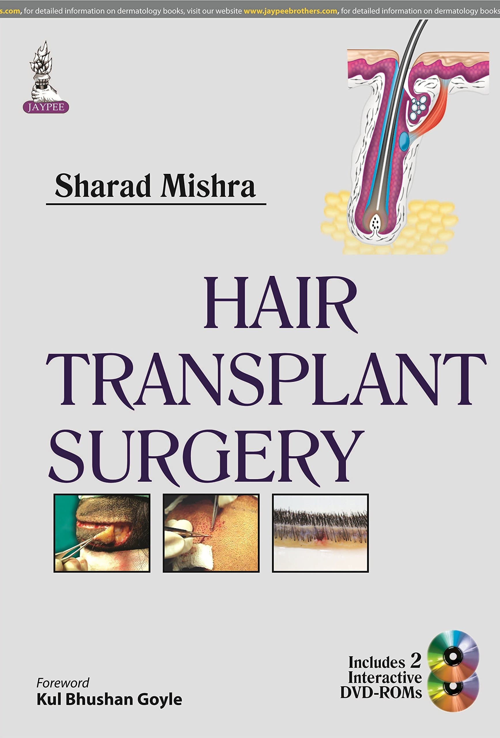 Hair Transplant Surgery 1st Edition